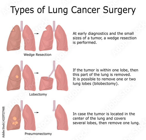 Types of Lung Cancer Surgery