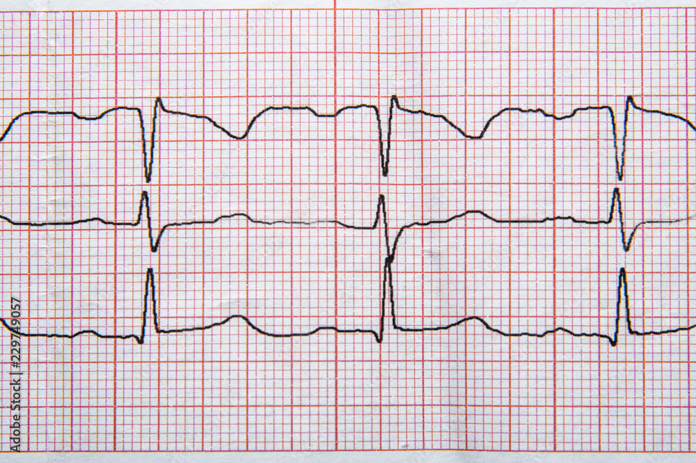 Medical research. Fragment of a normal electrocardiogram with arrhythmia elements.