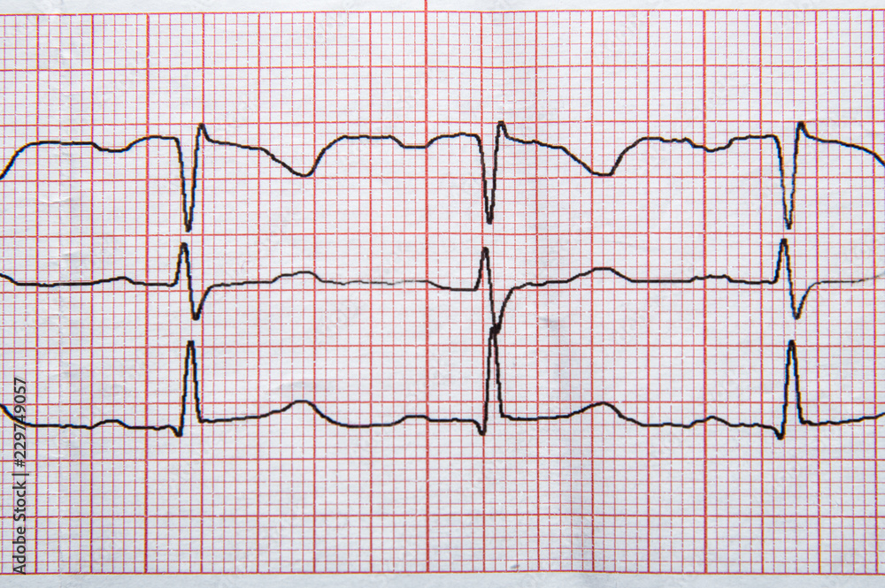 Medical research. Fragment of a normal electrocardiogram with arrhythmia elements. Medical research. Fragment of a normal electrocardiogram with arrhythmia elements.