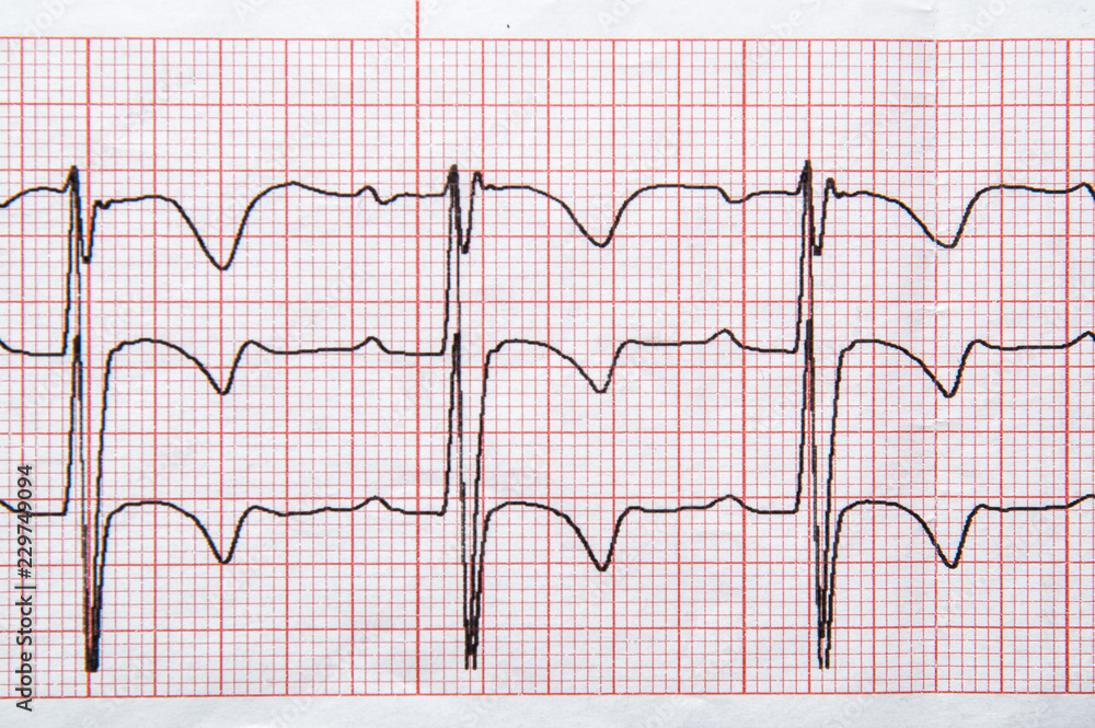 Medical research. Fragment of a normal children's electrocardiogram with arrhythmia elements.