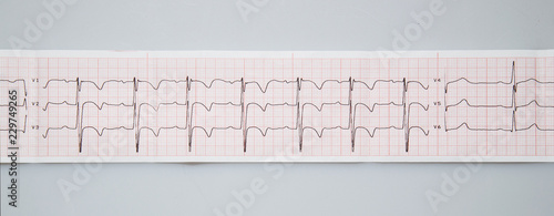 Medical research. Electrocardiogram. The normal result of electrocardiography in a 3-year-old child.