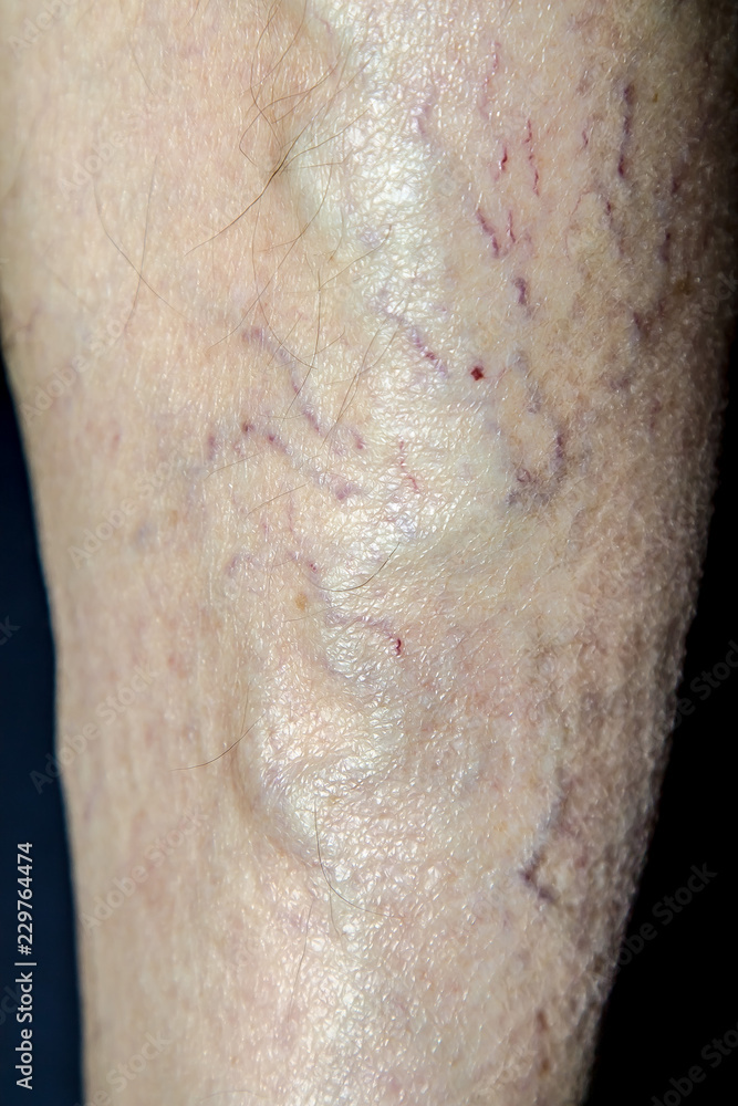 Fototapeta premium Varicose veins on the leg