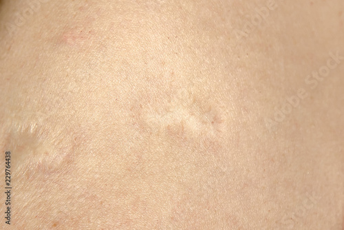 Scar from chickenpox vaccination