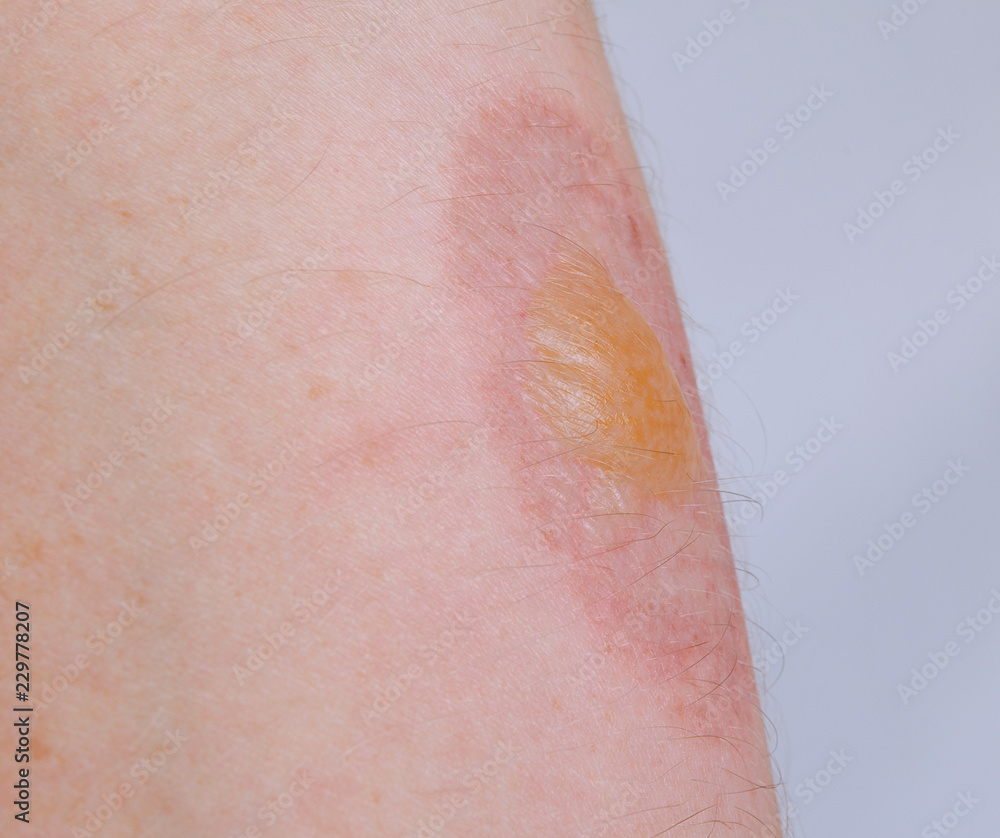Fototapeta premium Burn on human skin