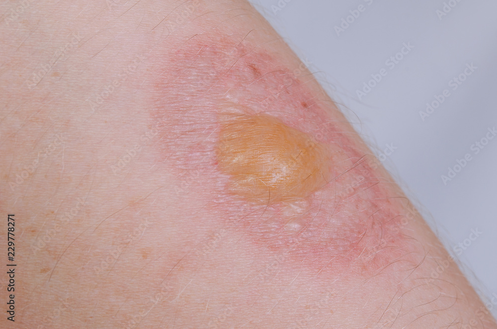 Fototapeta premium Burn on human skin