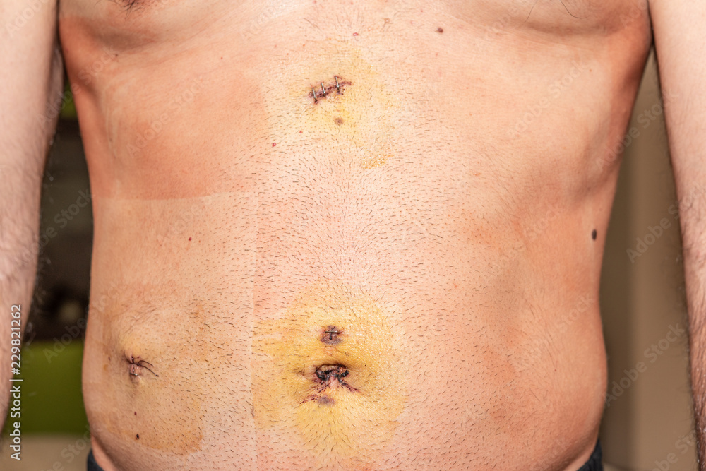Naklejka premium After surgery scars. Man's belly after laparoscopy. Metal staples. 