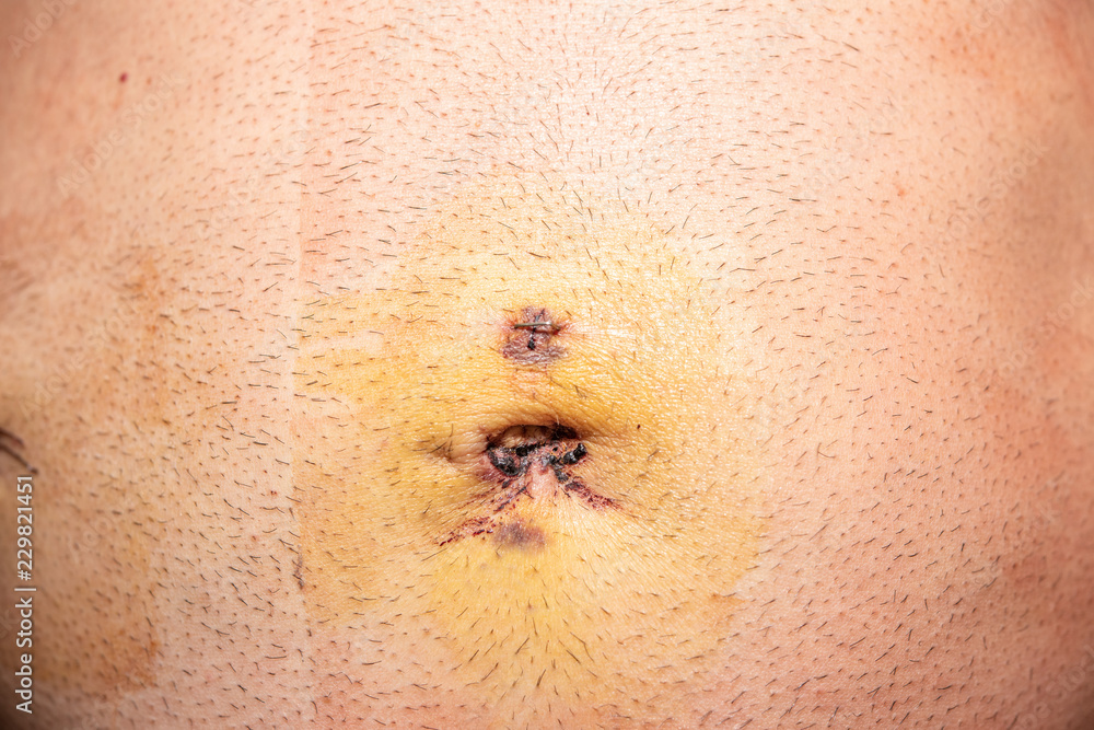Fototapeta premium After surgery scars. Man's belly after laparoscopy. Metal staples.