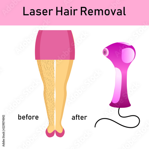 laser hair removal, legs of girl and a laser apparatus, vector illustration