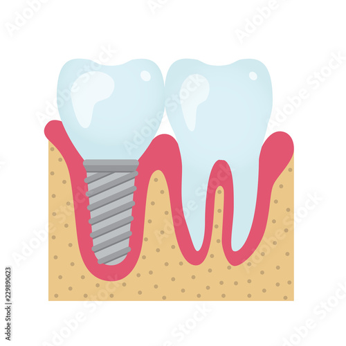 Dental crowns and implantation