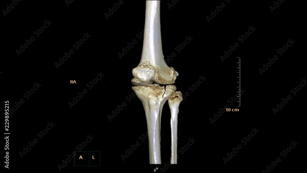 CT Scan of right knee 3d rendering image rotating on the screen . Medical technology Concept. CT Scan of right knee 3d rendering image rotating on the screen . Medical technology Concept.