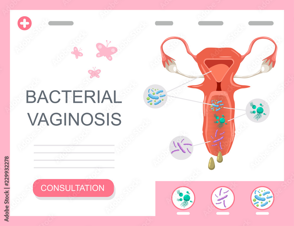 Bacterial Vaginosis Medical Infographics With Female Reproductive Organ bacterial-vaginosis-medical-infographics-with-female-reproductive-organ