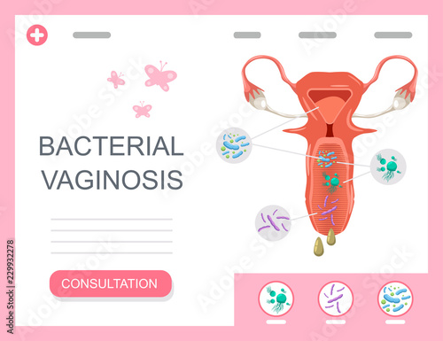 Bacterial vaginosis medical infographics with female reproductive organ with bacteria and microbes. Vector concept illustration. photo