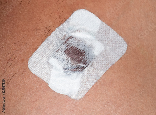 Bactericidal adhesive tape on the male nipple. Dressing after surgery on the nipple areola.