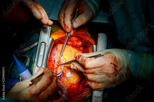 Fotografie Heart surgery. Open heart surgery suture greater saphenous vein