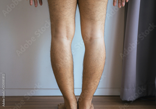 Asian man leg bandy-legged shape of the legs photo