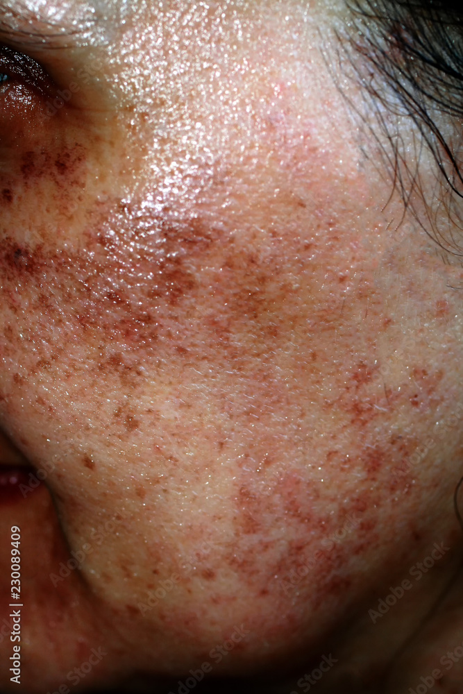 Fototapeta premium Pigmented spots on the face. Pigmentation on cheeks