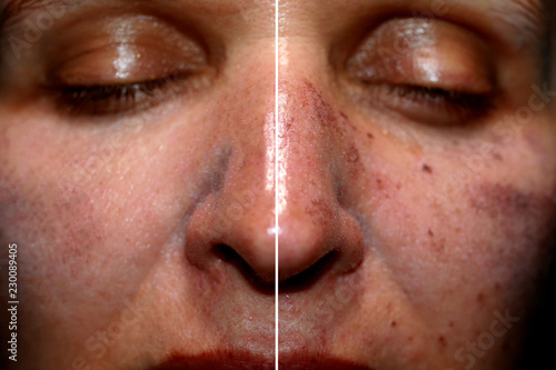 One half of the face in pigmentation and brown spots, the other side of the face after laser polishing and peeling photo
