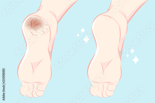 Feet with dry skin