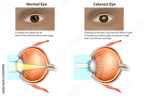 Сataract is a clouding of the lens. Medical illustration of a normal eye and an eye with a cataract, clouded lens