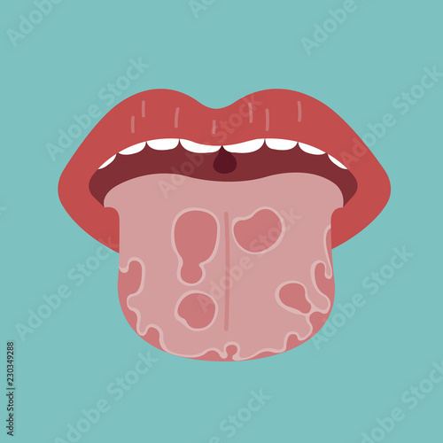 Tongue disease, vector of organ concept.