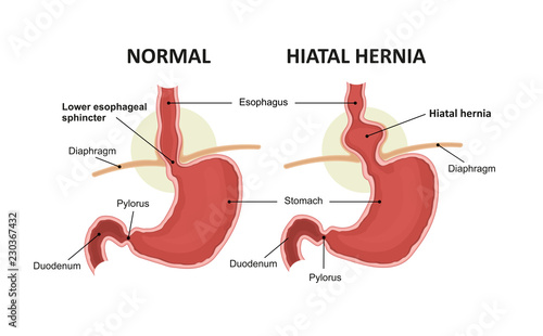 Hiatal hernia and normal anatomy of the stomach