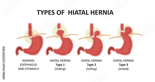 types of hiatal hernia