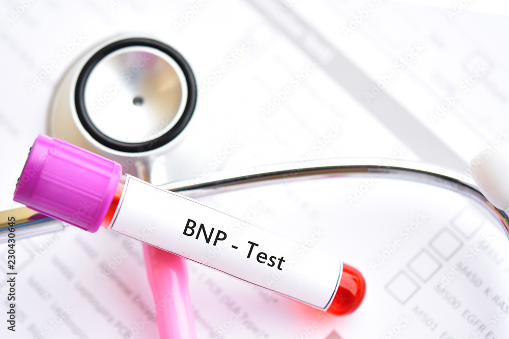 Blood sample for Btype natriuretic peptide or BNP test, cardiac marker