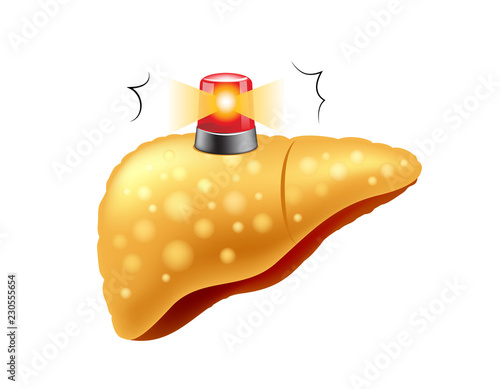 Fatty liver symbol with siren. Internal organ requires care or medical treatment due to disease or impact of adverse on health. health care concept. Vector illustration isolated on white background.
