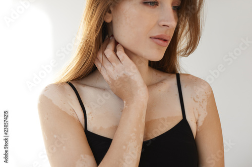 Horizontal close up portrait of attractive young female with vitiligo affected skin posing at white wall in black tank top, holding hand on her neck. People, beauty, cosmetology and depigmentation photo