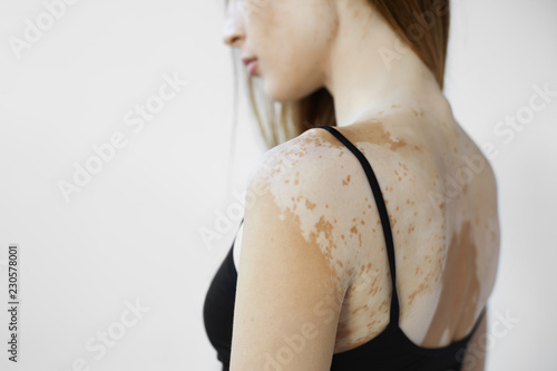 Cropped back view of beautiful young European woman with skin condition that causes loss of melanin posing indoors. Slender slim female model in black tank top suffering from vitiligo disorder photo
