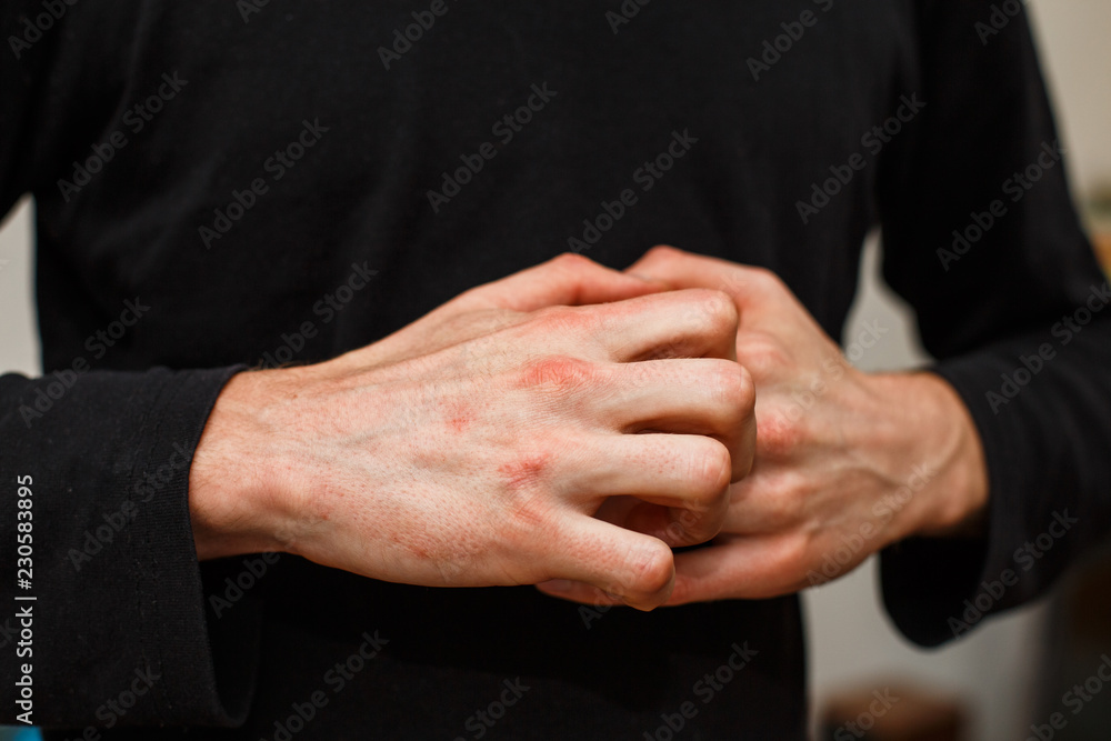 Man scratch oneself, dry flaky skin on hand with psoriasis vulgaris, eczema and other skin conditions like fungus, plaque, rash and patches. Autoimmune genetic disease. Man scratch oneself, dry flaky skin on hand with psoriasis vulgaris, eczema and other skin conditions like fungus, plaque, rash and patches. Autoimmune genetic disease.