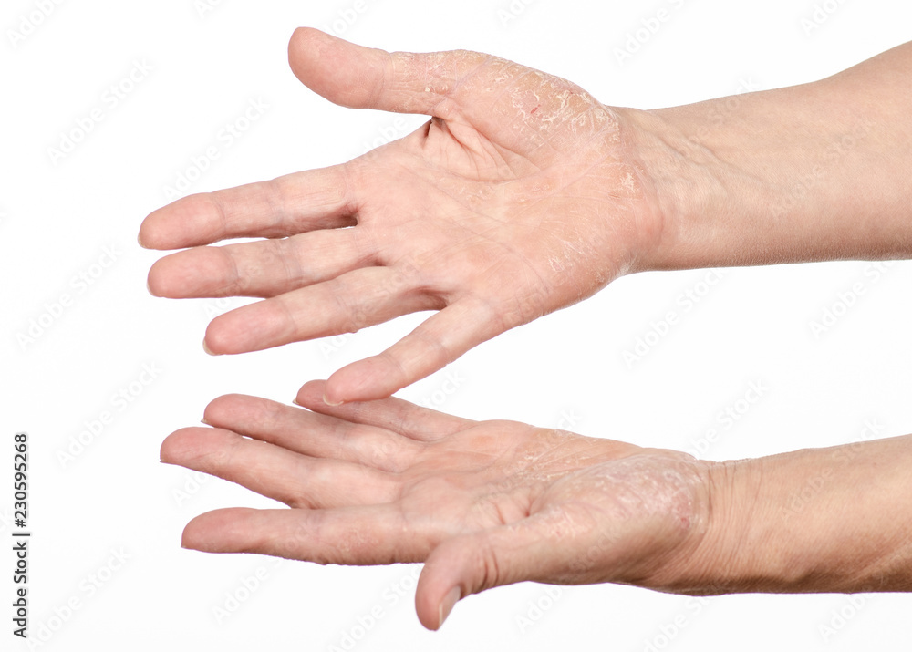 Female hands psoriasis on a white background. Isolation