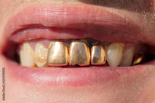 Golden teeth in the mouth of a man photo