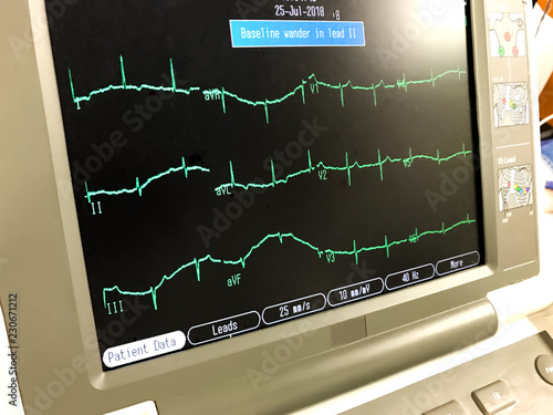 Obraz na plátne Monitor showing EKG with wandering baseline