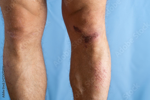 Abrasion on a man's knee on a blue background, close-up