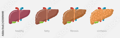 Flat design illustration of stages of liver damage