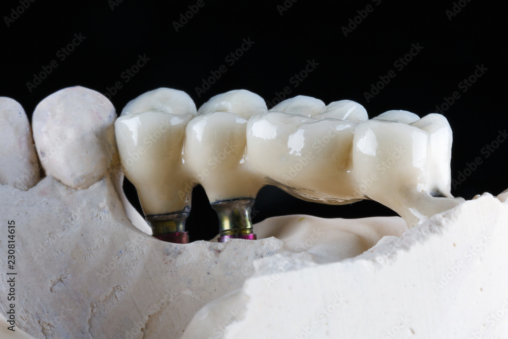 Ceramic Dental crowns chewy side, shot close-up on a black background Ceramic Dental crowns chewy side, shot close-up on a black background