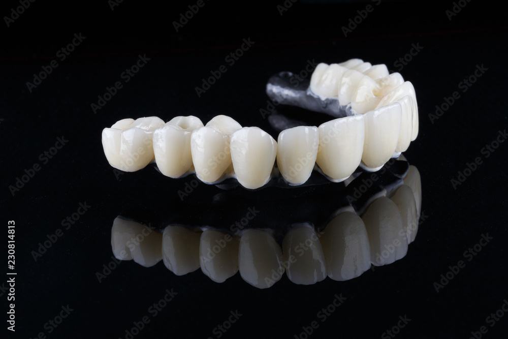 titanium beam with ceramic crowns of the upper jaw, shot at an angle on the black glass titanium beam with ceramic crowns of the upper jaw, shot at an angle on the black glass