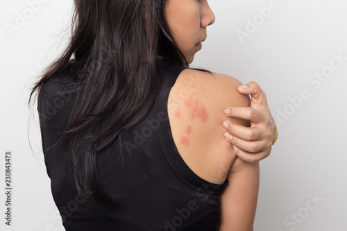 woman showing her skin itching behind , with allergy rash urticaria symptoms