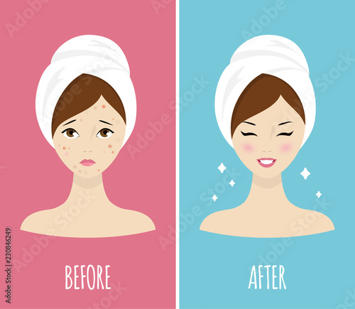 Acne skin - before and after treatment. Vector