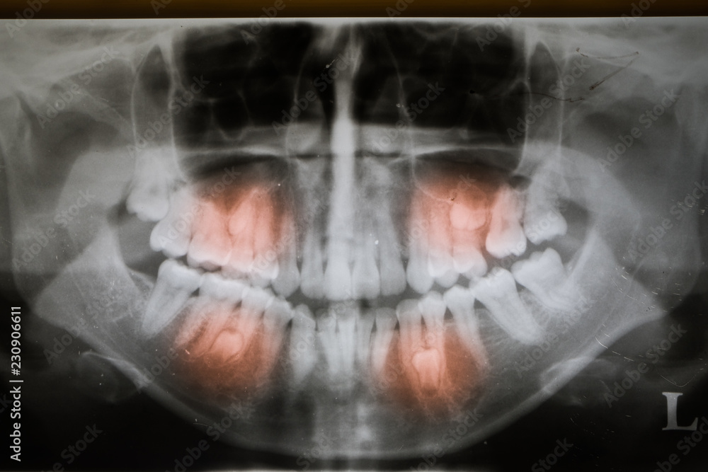 embedded impacted 4 bicuspid teeth on X-ray film Stock Photo | Adobe Stock