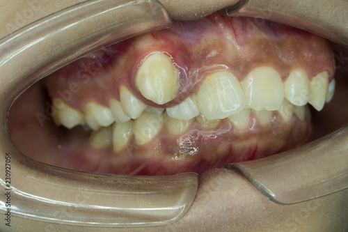 high position of canine tooth