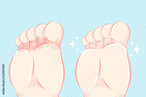 close up of Athlete foot photo
