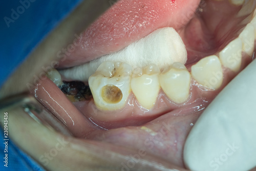 closeup of decayed teeth