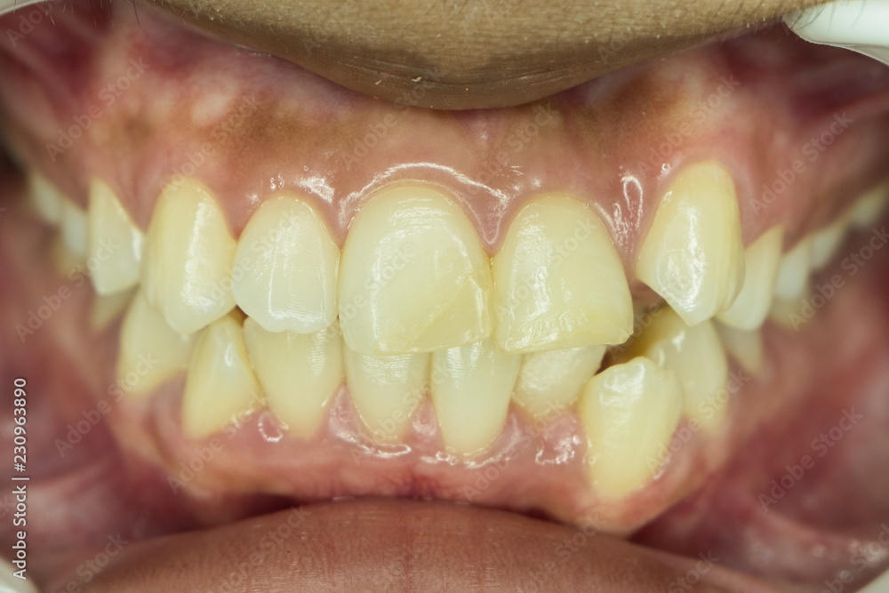 Obraz premium crowding teeth