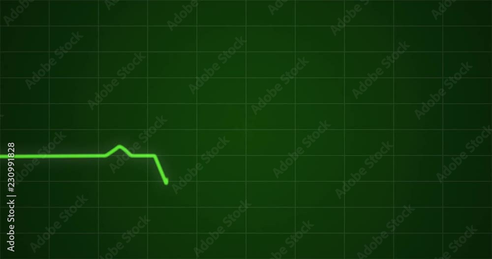 Concept animation of an ECG or EKG heartbeat cardiogram on a green monitor in 4k. Concept animation of an ECG or EKG heartbeat cardiogram on a green monitor in 4k.