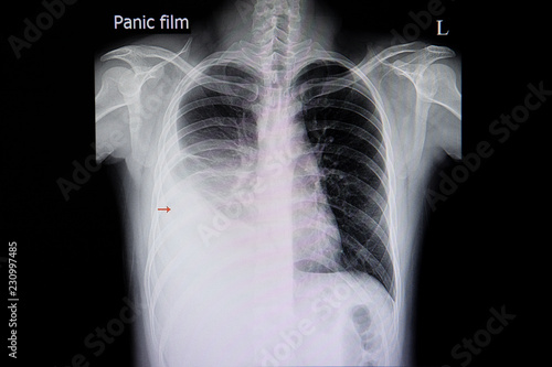 Pleural efffusion chest film photo
