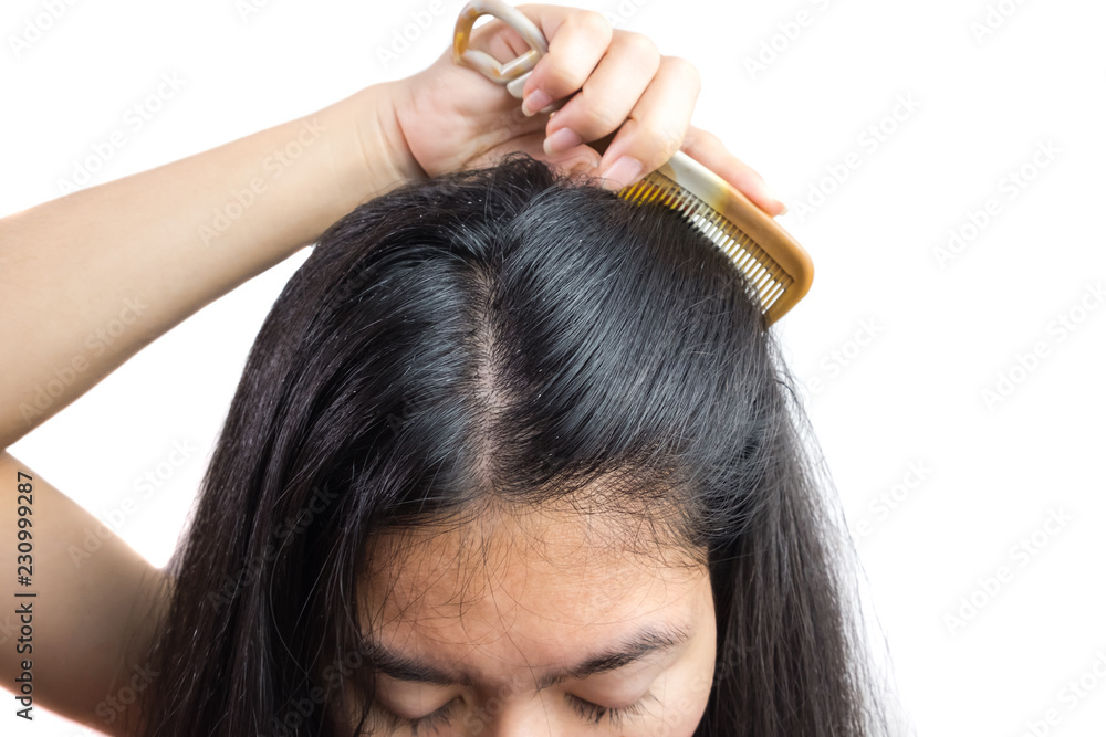 Fototapeta premium women head with dandruff Caused by the problem of dirty. Or caused by skin disease or Seborrheic Dermatitis. It has white scaly and it will cause itch. Product Concepts Scalp Care and Hair Care.
