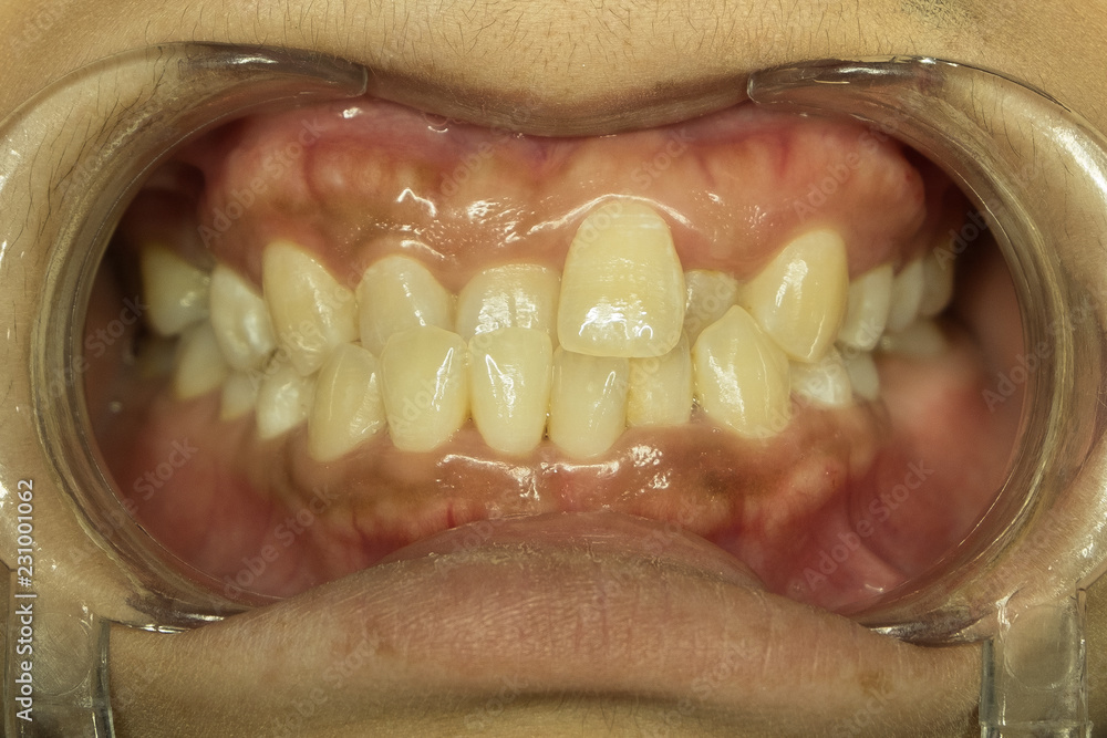 Obraz premium cross bite in front teeth
