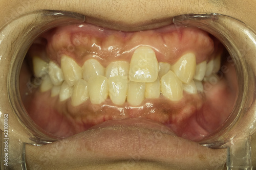 cross bite in front teeth
